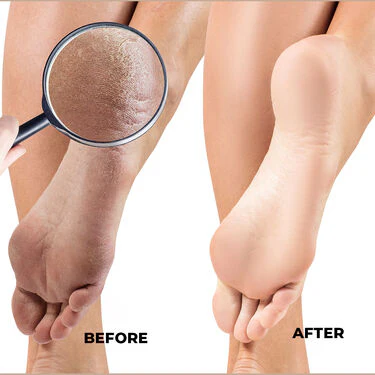 Foot Mask - For Brightening, Crack Heel & Dead Skin Remover + Pumice Stone (CFCK) - Image 7