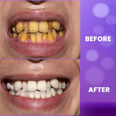Purple Teeth Whitening Gel - Image 6