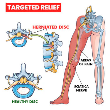 Sciatica Belt for Pain Relief (PRS49) - Image 4